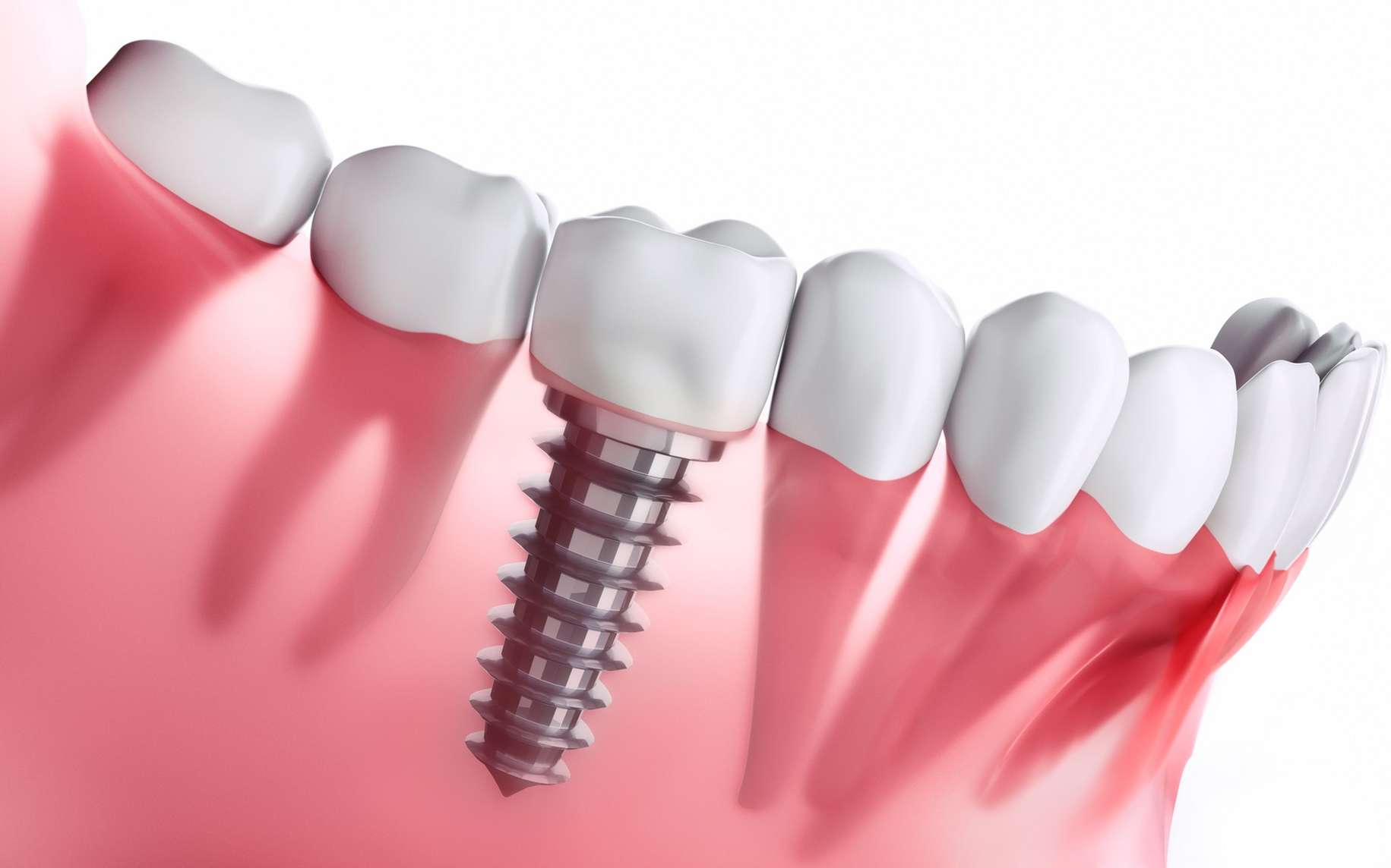 Implant dentaire : Un implant remarquable ?