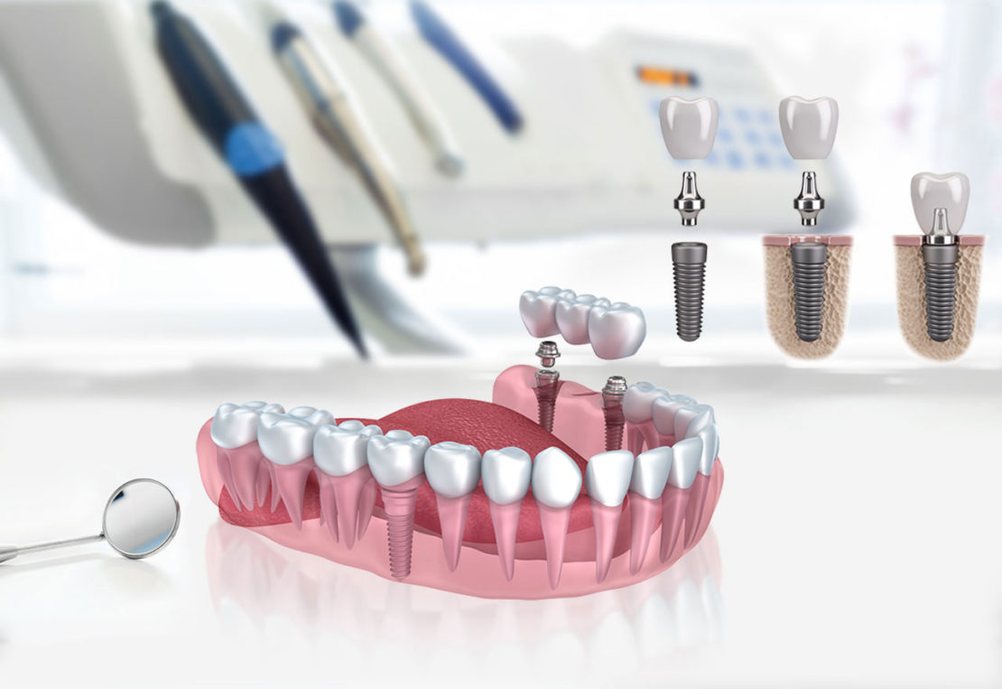 Implant dentaire : quels sont les différents avantages de ces prothèses dentaires ?